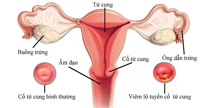 6 cách chữa viêm lộ tuyến tử cung tại nhà nhanh và dễ