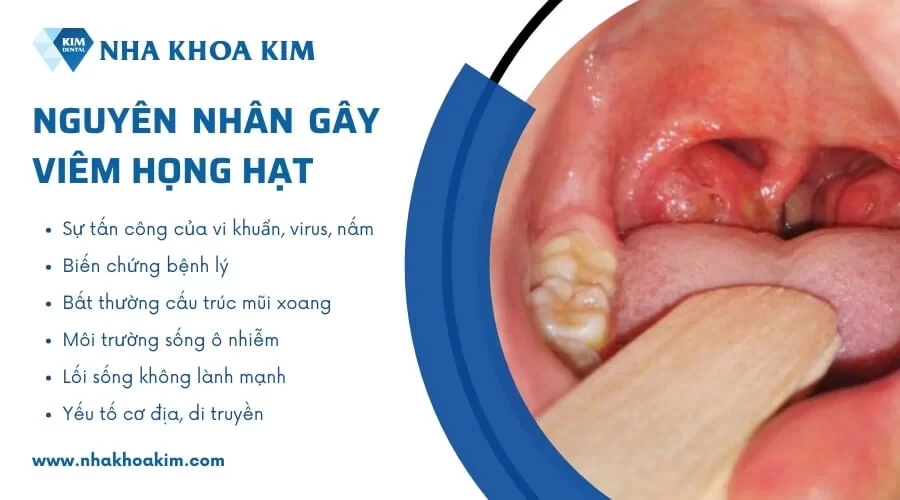 Viêm họng hạt: Nguyên nhân, Dấu hiệu và cách chữa trị