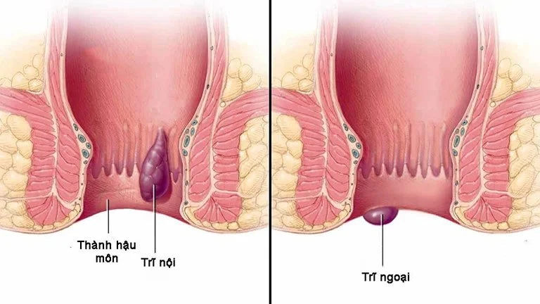 Thuốc chữa trĩ tốt nhất hiện nay bạn nên biết